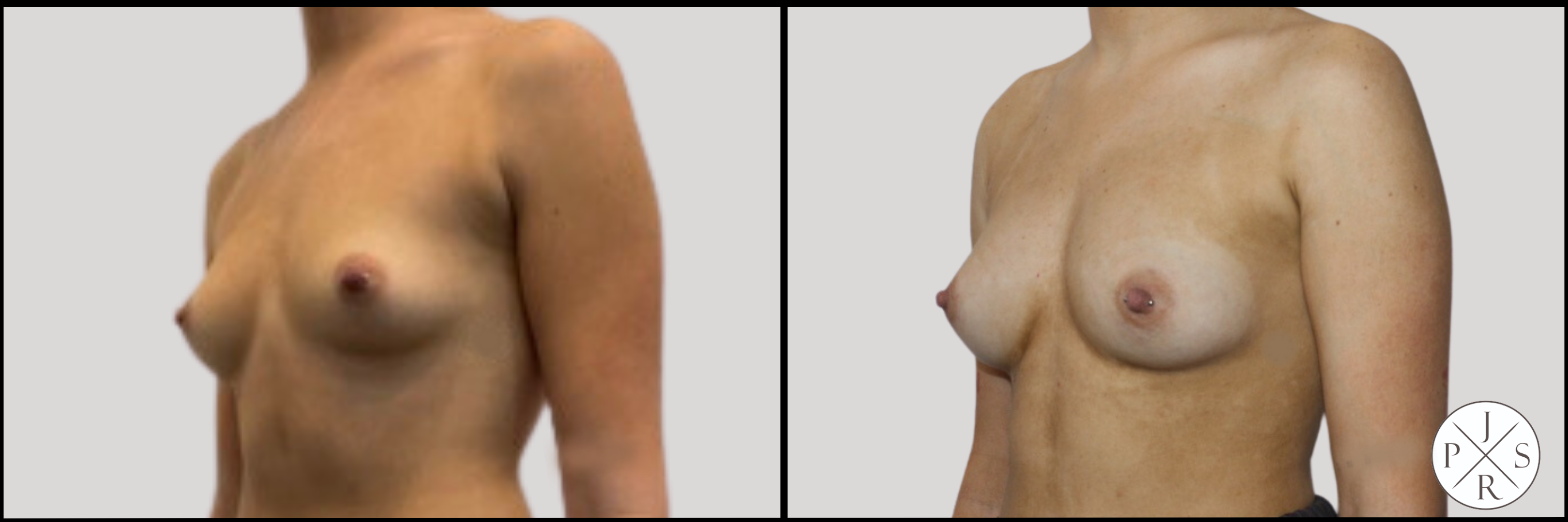 Fat Transfer Breast Augmentation Before & After Image